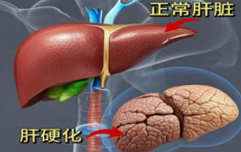 【怀医科普】肝脏弹性检测：早发现肝损伤，守住肝脏健康“预警线”——减肥党们看过来​