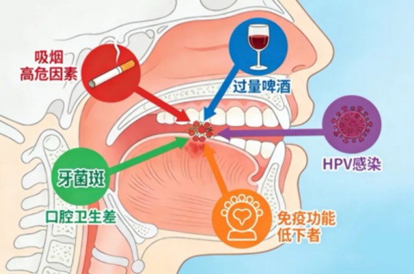 【6·16口腔癌筛查日】久溃不愈需警惕!省部级课题守护百姓口腔健康